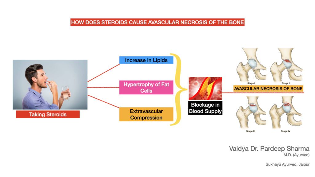 Post-Covid Avascular Necrosis 