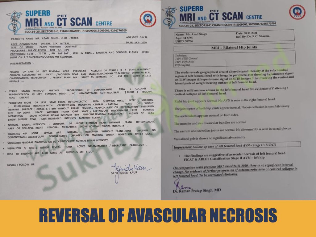 reversal of avascular necrosis