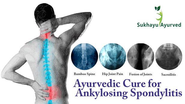 Ayurvedic Treatment of Ankylosing Spondylitis