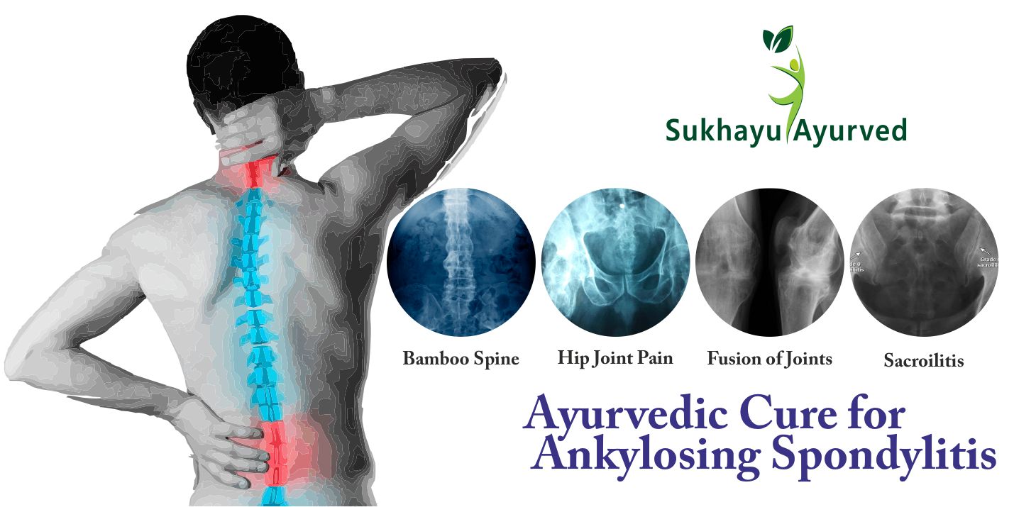 Ayurvedic treatment for Ankylosing spondylitis