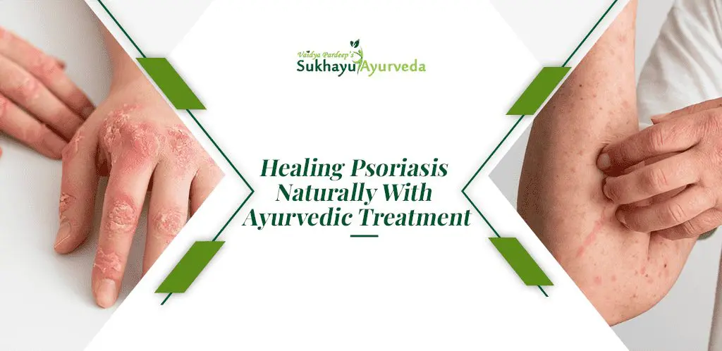 Ayurvedic Treatment For Psoriasis Sukhayu Ayurved Jaipur ayurvedic-treatment-for-psoriasis-sukhayu-ayurved-jaipur