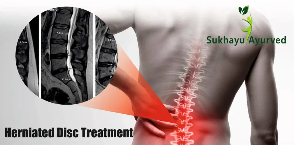 Lumbar Herniated Disc Symptoms, Surgery & Treatment