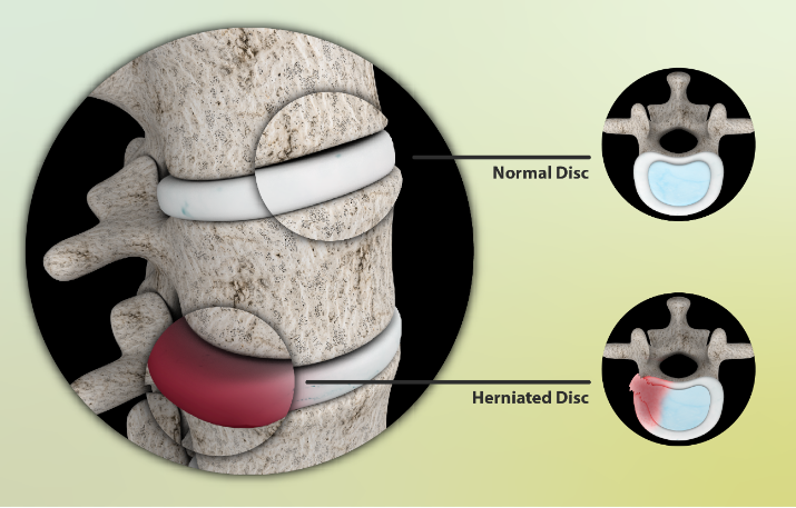 Normal Disc - Herniated Disc